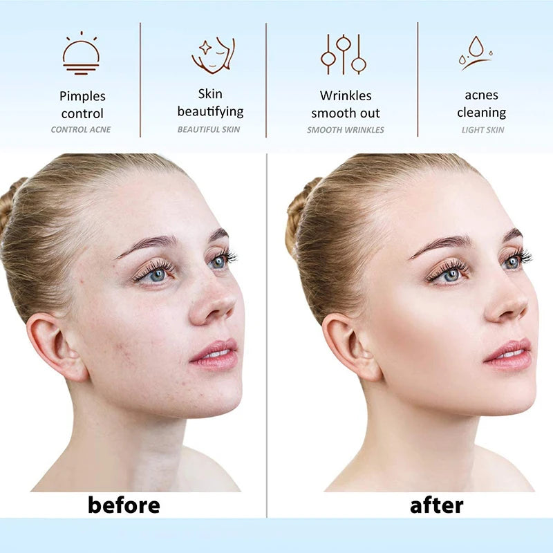 High Frequency Facial Wand – Neon Glass Electrode Skin Therapy Device for Acne & Anti-Aging