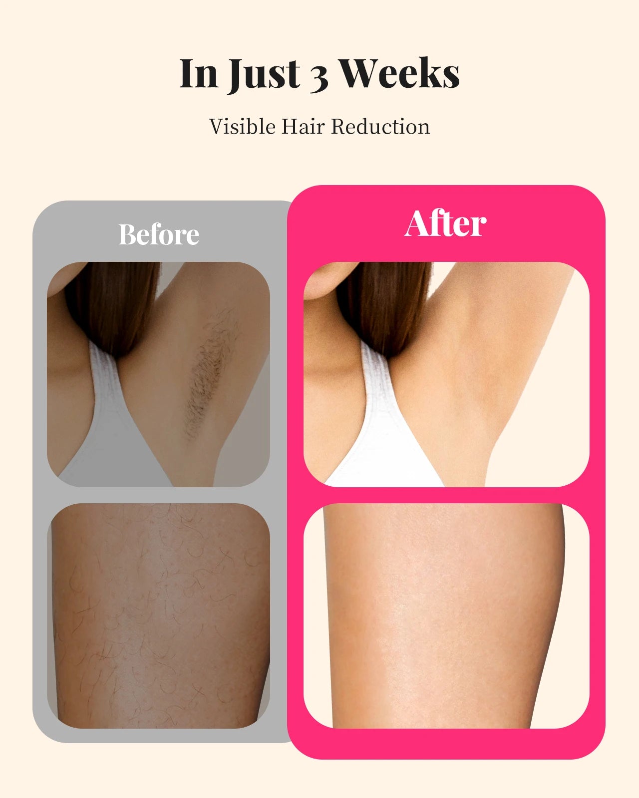 IPL Laser Hair Removal Device – 990,000 Flashes Permanent Hair Reduction for Face & Body